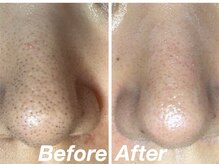 スウ(su:)/毛穴のお悩みもお任せください