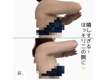 グレース(Grace luxe)/二の腕ケアもお任せください！