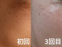 サロンドミミ(Salon de Mimi)/毛穴洗浄＆ハーブピーリング☆