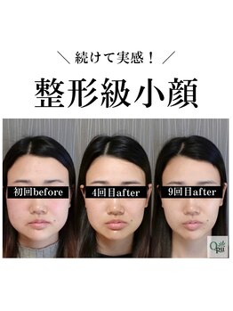 キュープ 広島店(Qpu)の写真/むくみ・歪み・たるみ・エラ張りも根本からケア！理想のフェイスラインへ◎