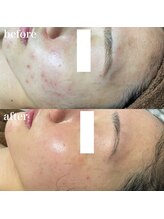 ナチュレ(Nature)/ハーブピーリングbefore→after