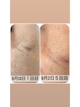 エクボ(EcBeau)/脇脱毛の症例です☆全身脱毛