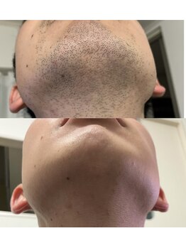 ラウレアサロン(laule'a salon)/ビフォー/アフタ-