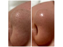 トータルビューティーサロン ハルキ(TOTAL BEAUTY SALON HARUKI)の雰囲気（毛穴汚れをゴッソリ！特殊な美容液を使い浮き上がらせ吸引します）