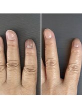 桃の木 吉祥寺店/代謝の悪い爪も改善！1