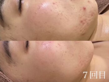 アワピール 天王寺店(AWA PEELL)/ハーブピーリング/ニキビケア