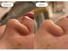 リスタ(RSTA)/【BEFORE/AFTER】