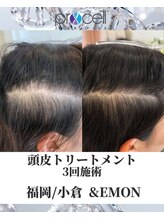 アンドエモン(&EMON)/【頭皮】プロセル効果