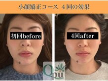 キュープ 表参道店(Qpu)/続けた方しか感じられない変化♪