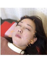 よつば鍼灸整骨院 春日院/美容鍼