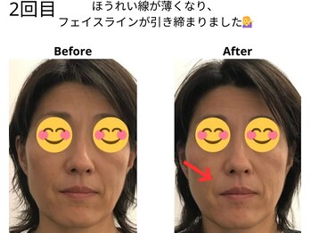 ベル/50代の方の小顔Before After
