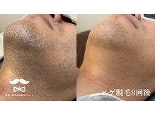 シエル(ciel.)/効果抜群！！メンズ脱毛！