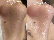 レシェルサロン(Lechelle Salon)/ハーブピーリング＋ダーマエステ