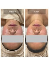 エミニー(EMINY)/ララピール1回before→after