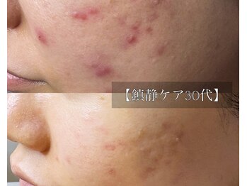 ル シーニュ/鎮静ケア30代