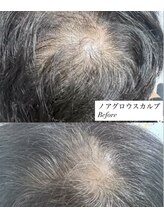 ニューユー(NewYou)/ノアグロウスカルプ