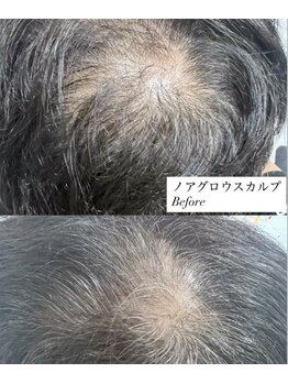 ニューユー(NewYou)/ノアグロウスカルプ