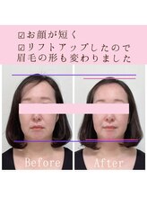 ビーホリック(Bholic)/全体的な下がり感、頬のたるみ