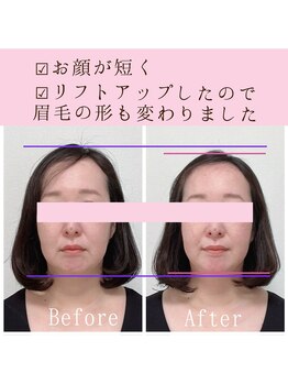 ビーホリック(Bholic)/全体的な下がり感、頬のたるみ