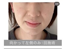 エラフリー/リフトケア☆1回のケア後（左）