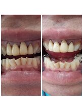 おうちサロン しゅろ/美容セルフホワイトニング