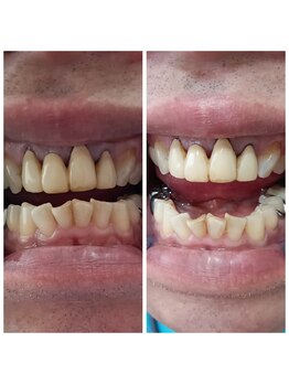 おうちサロン しゅろ/美容セルフホワイトニング