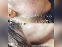 オーパーツ(OOPARTS)/ハーブピーリング/エステ/下北沢