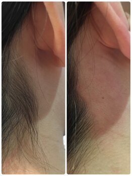 ダブルオー 銀座(00)/美容電気脱毛/うなじ