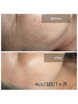 ラヴィブリエ 京橋/臍帯由来ヒト幹細胞100%原液導入