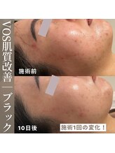 チャム(cham)/VOS肌質改善/ニキビ凹凸毛穴ケア