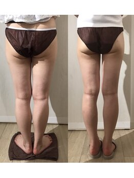 プルーラントエステ キョウト ビジョーラ(PullulantEsthe Kyoto×BEJORA)/痩身10回ビフォーアフター