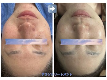 オーロラ(Aurora)/タラソトリートメントで蘇り☆