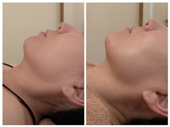 アリュール(allure)/顔コリほぐし＋レモンボトル