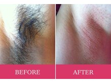 マロズワックス ブラジリアンワックスアンドスパ(Maro's Wax Brazilianwax Spa)/ワキWax★Before After