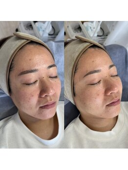 サニーヒルズ ウィズ マキア 藤沢(Sunny hills with MAQUIA)/カーボキシー炭酸パック