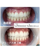 ホワイトニングサロン 京都烏丸店/ホワイトニング施術例