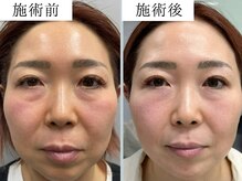 サロンドモフィ(salon de moffy)/美肌【エクソリフト】施術例６