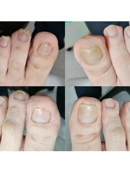 【肥厚・変形爪】ネイル/フット