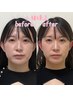 【小顔・頭蓋骨調整】エラ/顔の歪み/顎関節/人中短縮！50分¥12000→¥7000