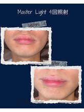 レオナルド(Leonardo)/ヒゲ照射4回