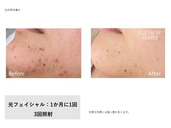 サロン ダリア(Salon Dahlia)/光フェイシャル