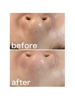 ゴールデンケア(goldencare)/毛穴 変化