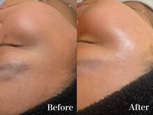 ラナ(Lana)/白玉フェイシャルワックス脱毛