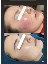 ノヴェイル(NoVeil)/施術後