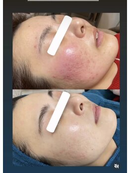 ノヴェイル(NoVeil)/施術後