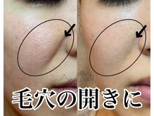 アンドピエル(AndPiel)/頬の毛穴の開きにお勧め！