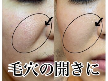 アンドピエル(AndPiel)/頬の毛穴の開きにお勧め！