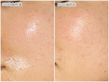 おうちサロン ミキ/毛穴の引締めにはビタミンA