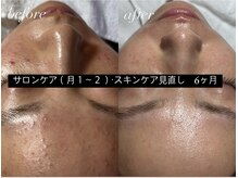 スパークル/毛穴/脱毛/ワックスフェイシャル