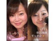 スキンラボ 新宿(@SkinLabo)/水光肌リフティング★ナノ超音波